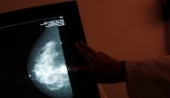 A monitor shows the image of a breast cancer at a centre run by the 