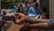 A patient suffering from mpox sits on a bench at the Kavumu hospital, 30 km north of Bukavu in eastern Democratic Republic of Congo, August 24, 2024. Photo by Glody MURHABAZI / AFP