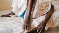 A man infected with Mpox lies on a bed inside a ward at the Kamenge University Hospital's Mpox treatment center in Bujumbura on August 22, 2024. Photo by Tchandrou NITANGA / AFP