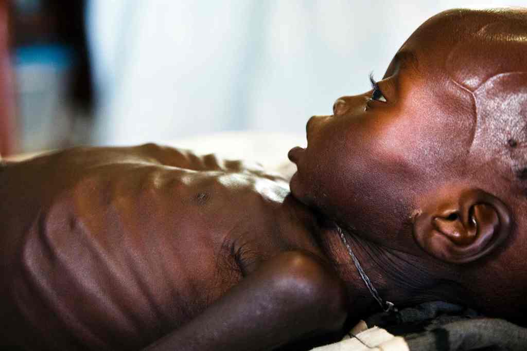 (FILES) This file photo taken on October 11, 2016 shows Agop Manut (11 months), who suffers acute malnutrition and respiratory distress, assisting at the clinic run by Doctors without Borders (MSF) in Aweil, Northern Bahr al Ghazal, South Sudan. AFP / ALB