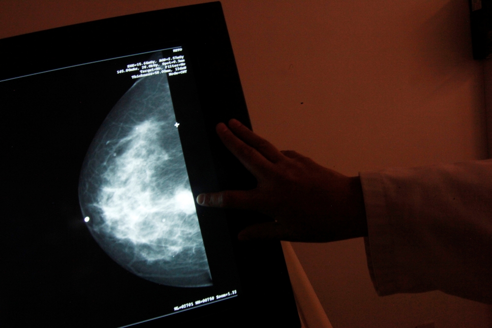 A monitor shows the image of a breast cancer at a centre run by the 