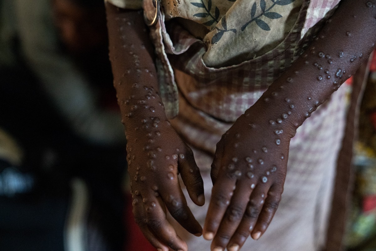 A patient with a severe form of the mpox epidemic is treated at the Kavumu hospital, 30 km north of Bukavu in eastern Democratic Republic of Congo, August 24, 2024. (Photo by Glody MURHABAZI / AFP)
