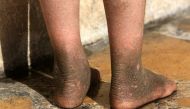 The skin on five-year-old Doaa's feet is blackened after a rocket fired by Islamic State landed and exploded in Qayyara, Iraq, November 12, 2016. REUTERS/Air Jalal
