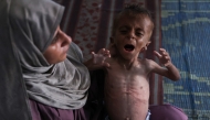 File photo of a Gazan mother carrying her son who is showing signs of malnutrition. AFP.