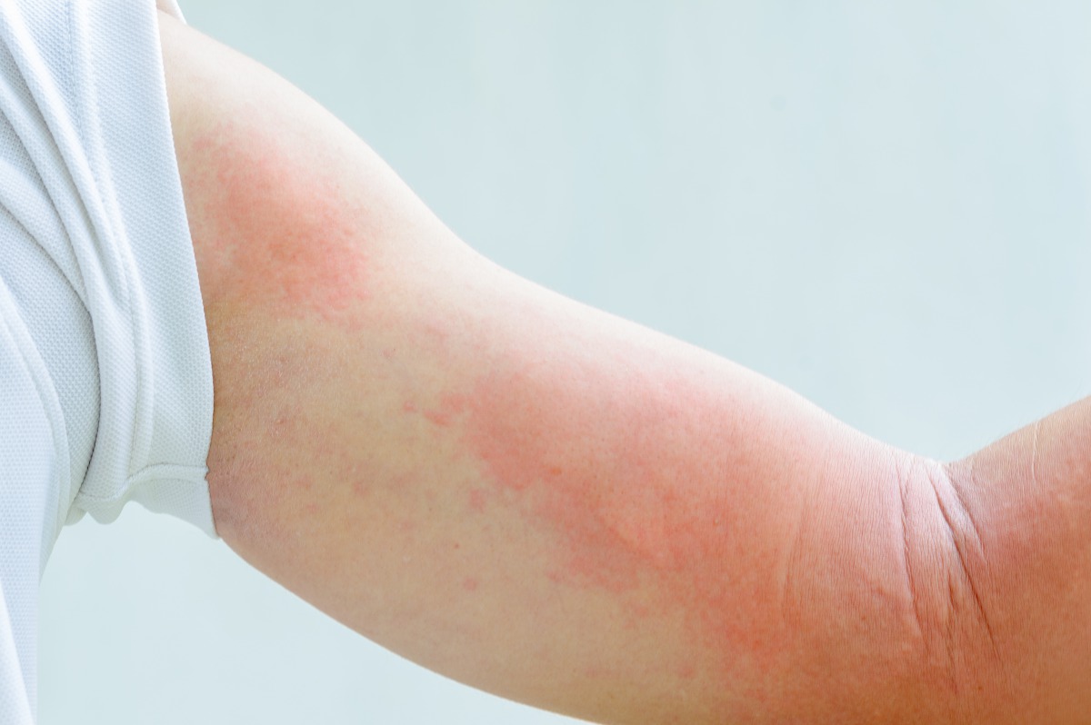 Symptoms of an allergic reaction to insect bites can include rash