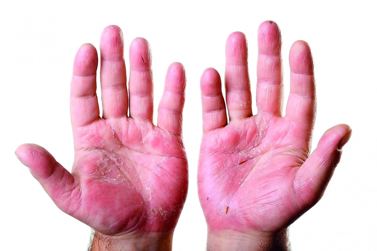 Palmoplantar pustulosis is a chronic condition affecting the palms and soles. Many people with psoriasis experience anxiety, embarrassment and depression.
