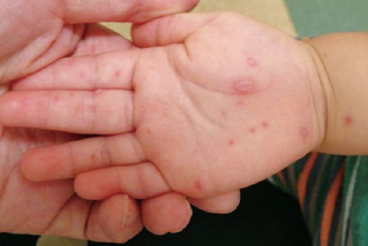 A child's hand after diagnosed with hand, mouth, and foot disease.