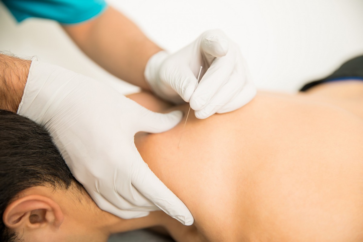 A physical therapy technique called dry needling is gaining popularity.
