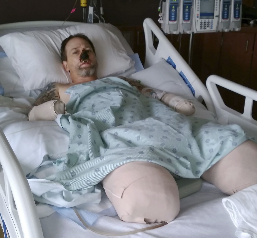 Gravely ill, Greg Manteufe lost parts of his arms and legs, as well as the skin of his nose and part of his upper lip. The cause was capnocytophaga (cap-noh-seye-TOE'-fah-gah), a germ from Ellie's mouth or from another dog he encountered. Photo courtesy: 