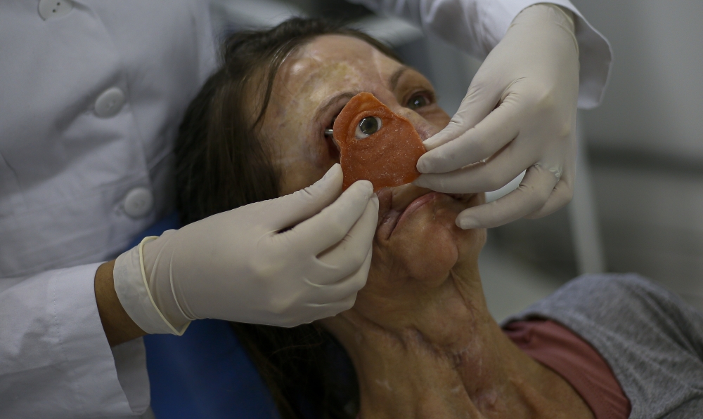 A doctor tests an eye implant on Denise Vicentin, who lost her right eye and part of her jaw to cancer, in Sao Paulo, Brazil, on November 1, 2019. AFP / Miguel Schincariol
 